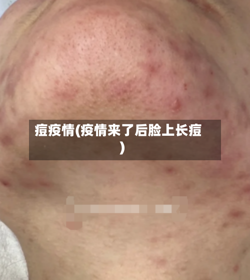 痘疫情(疫情来了后脸上长痘)