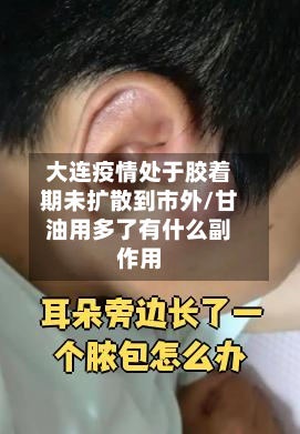 大连疫情处于胶着期未扩散到市外/甘油用多了有什么副作用-第3张图片